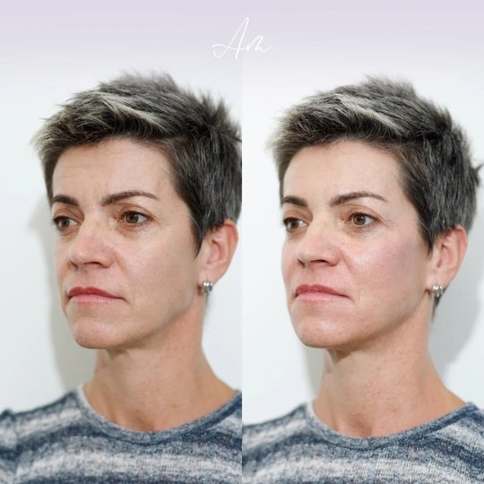 tratamiento de rellenos de acido hialuronico en la palma