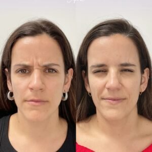 tratamiento de neuromoduladores en la palma