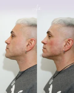 marcacion mandicular con acido hialuronico